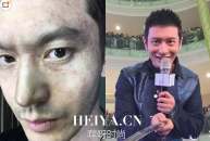 黄晓明血管爆破是怎么回事什么意思   黄晓明整容后遗症脸还能复原吗
