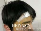 王俊凯受伤严重吗 王俊凯受伤图片