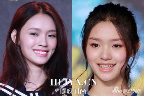 林允的牙齿有明显变化