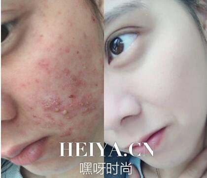 日本狮王祛痘膏有效吗 什么牌子的祛痘膏好用