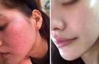 怎么修复敏感肌？过敏修复最快的方法